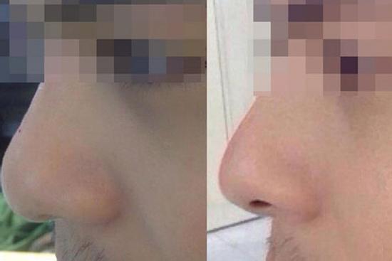 Người đàn ông có nguy cơ mù mắt sau khi tiêm filler nâng mũi làm đẹp