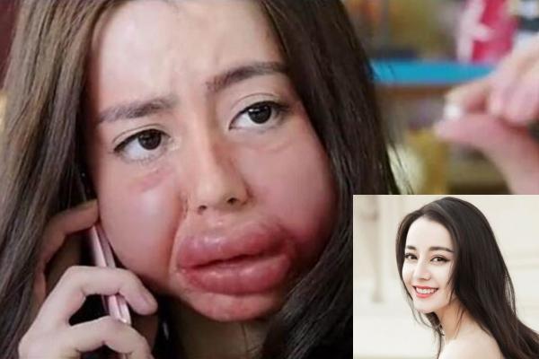 Trong phim Ngạo kiều và định kiến, nhân vật của Địch Lệ Nhiệt Ba bị dị ứng phấn hoa khiến cả gương mặt sưng phù xấu xí.