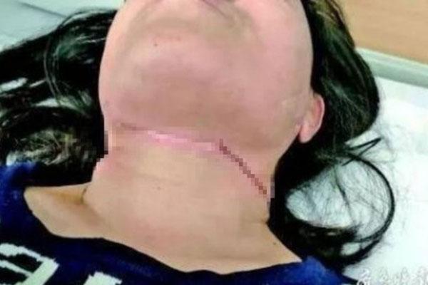 Người phụ nữ bị dây diều cứa cổ khi đang đi xe máy-1