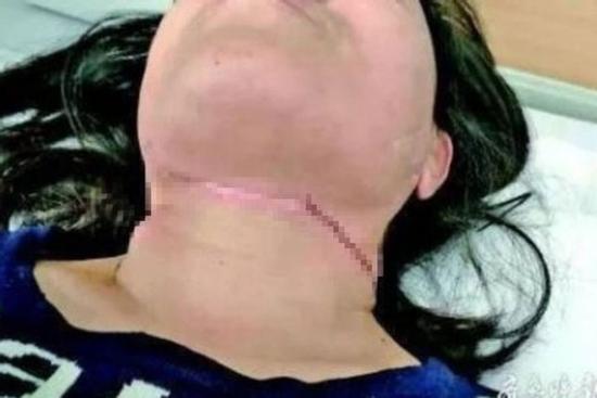 Người phụ nữ bị dây diều cứa cổ khi đang đi xe máy