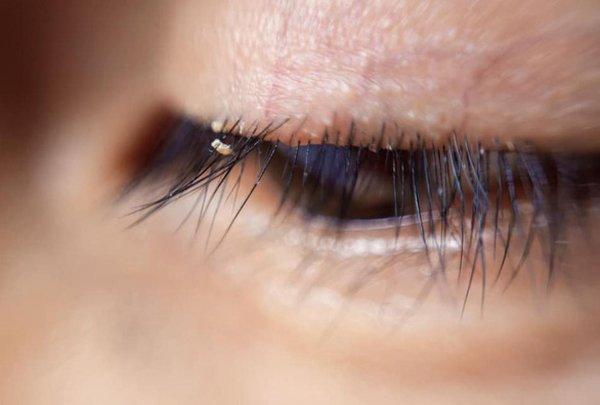 Còn ai muốn nối mi giả khi nhìn thấy ổ chấy rận ký sinh trên nơi đáng sống này?-1