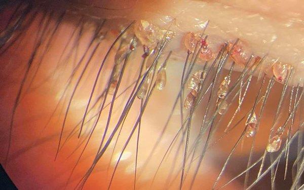 Còn ai muốn nối mi giả khi nhìn thấy ổ chấy rận ký sinh trên nơi đáng sống này?-7