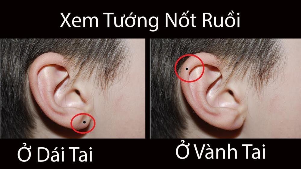 Nốt ruồi ở tai dự báo tương lai, vận mệnh của bạn như thế nào?-1