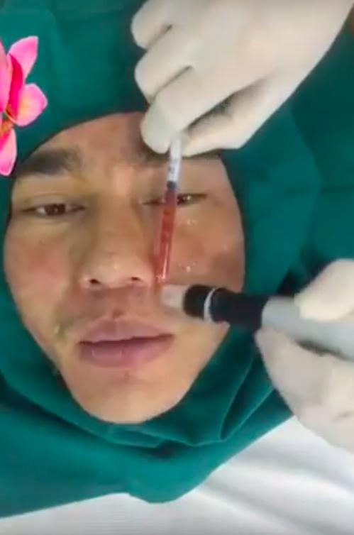 Lê Dương Bảo Lâm thừa nhận đập đi xây lại cả gương mặt, nghiện phẫu thuật thẩm mỹ chỉ sau Lê Giang-6