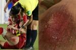 Vết thương đau rớm máu đến không ngủ được sau trận thắng Thái Lan, cầu thủ nữ tuyển Việt Nam làm fans xót xa