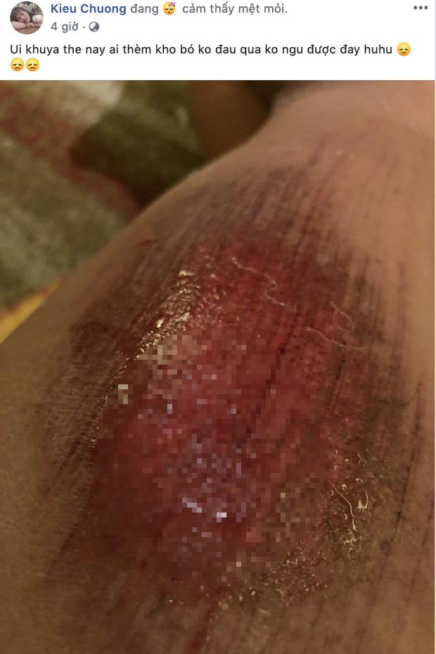 Vết thương đau rớm máu đến không ngủ được sau trận thắng Thái Lan, cầu thủ nữ tuyển Việt Nam làm fans xót xa-2