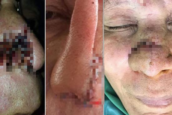 Cần Thơ: Cháu nhậu say cắn mũi bác rồi nuốt luôn vào bụng