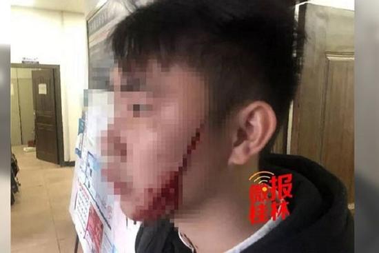 Rạch mặt bạn trai vì đòi chia tay