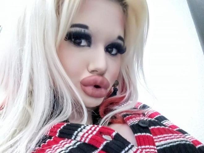 9X tiêm axit 17 lần để có đôi môi lớn nhất thế giới-1