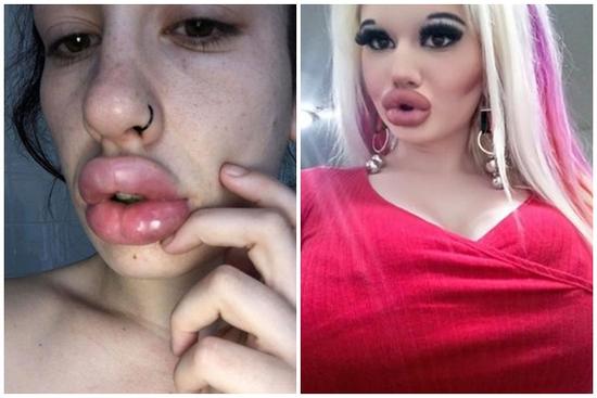 9X tiêm axit 17 lần để có đôi môi lớn nhất thế giới