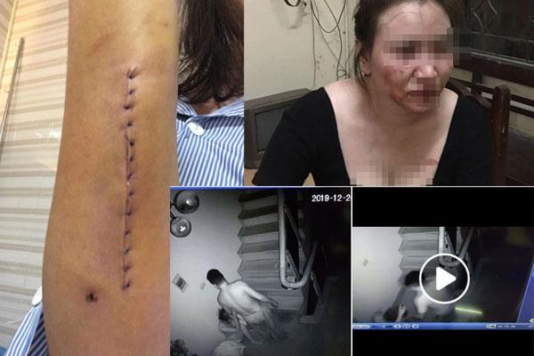 Ăn ốc không chịu để phần, vợ bị chồng hắt nước sôi vào mặt gây bỏng nặng-2