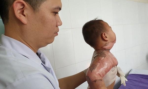 Ngã vào nồi lẩu đang sôi trẻ bỏng nặng-1