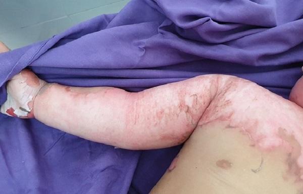 Ngã vào nồi lẩu đang sôi trẻ bỏng nặng-2