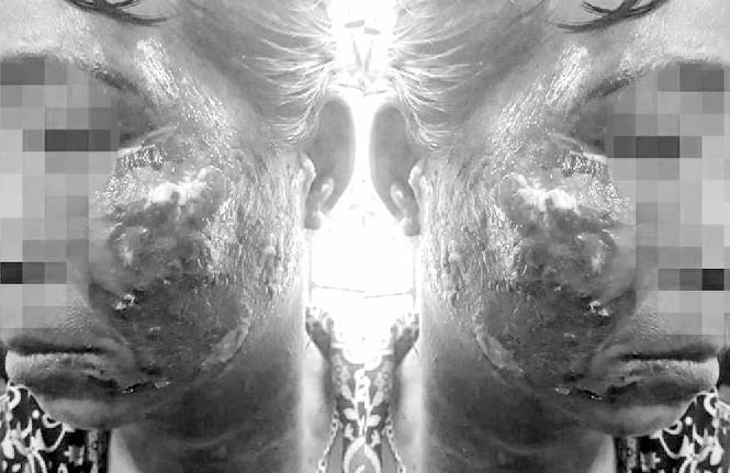 Ăn ốc không chịu để phần, vợ bị chồng hắt nước sôi vào mặt gây bỏng nặng-1