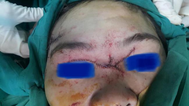 Lại có thêm trường hợp bé 4 tuổi bị chó Pitbull tấn công, đứt khí quản, rách vùng cổ ngực-1