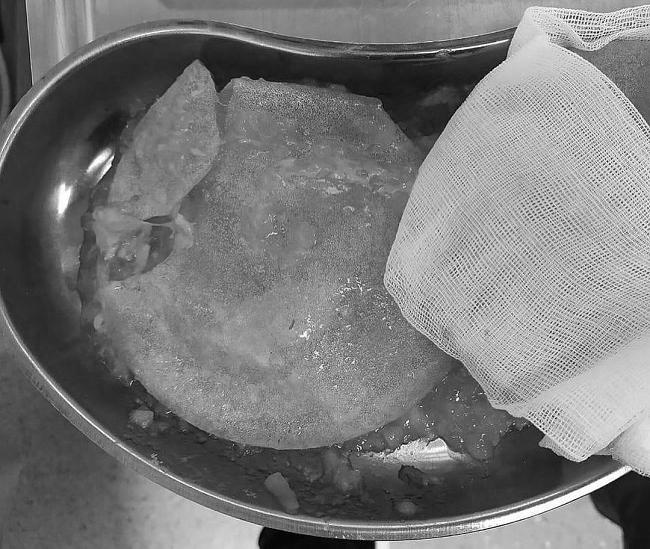 MC người Nga bị rách túi ngực sau 15 năm phẫu thuật-2