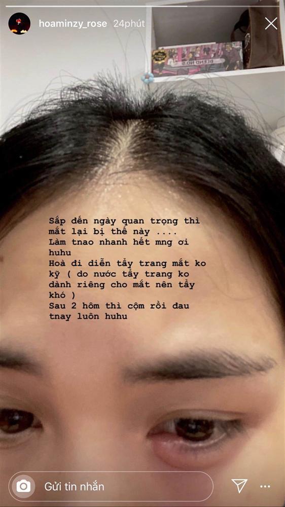 Tẩy trang không đúng cách, Hòa Minzy cuống cuồng cầu cứu cộng đồng mạng cách chữa đôi mắt sưng phồng-2