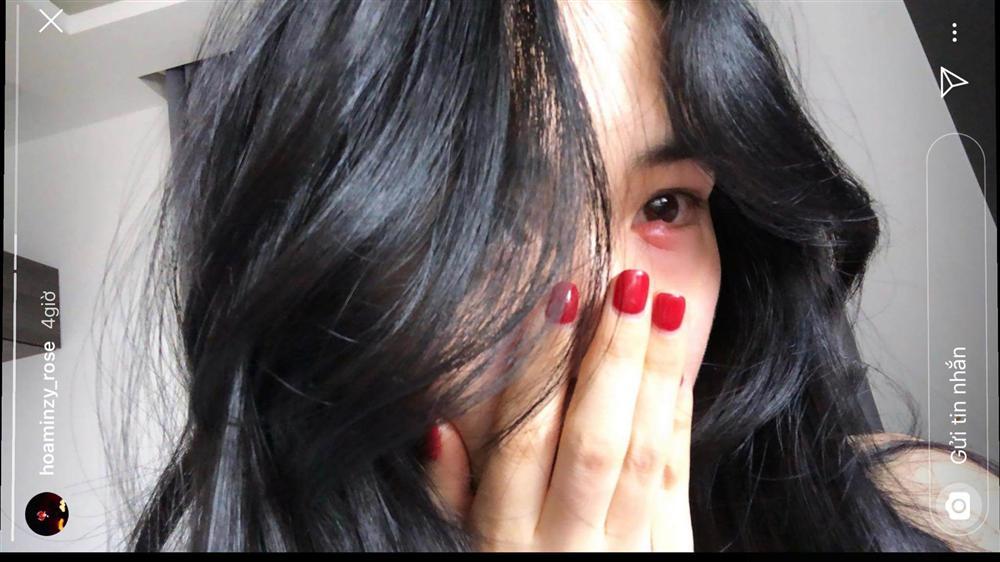 Tẩy trang không đúng cách, Hòa Minzy cuống cuồng cầu cứu cộng đồng mạng cách chữa đôi mắt sưng phồng-3