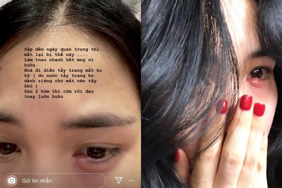 Tẩy trang không đúng cách, Hòa Minzy cuống cuồng 'cầu cứu' cộng đồng mạng cách chữa đôi mắt sưng phồng