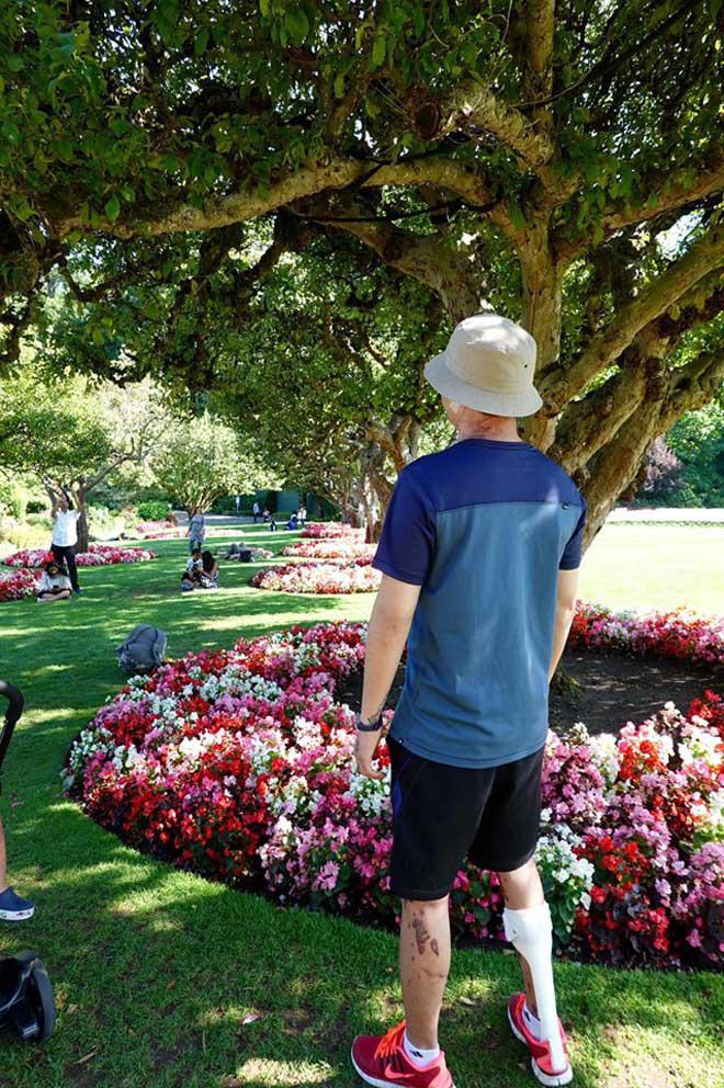 Hình ảnh mới của Việt kiều Canada sau gần 1 năm bị cắt gân chân và tạt axit khi về quê ăn Tết-6