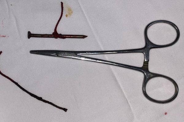 Tai nạn kinh hoàng lúc làm việc: Người đàn ông bị cây đinh cắm thẳng vào mắt trái, phải múc bỏ nhãn cầu-1