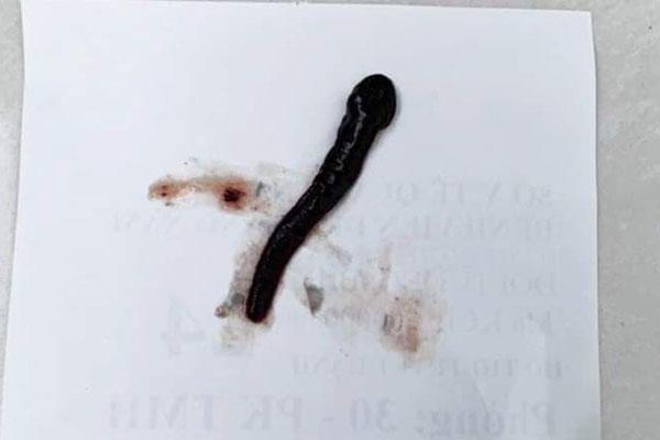 Kinh hãi con đĩa sống trong mũi bé gái 8 tuổi suốt 10 ngày-1