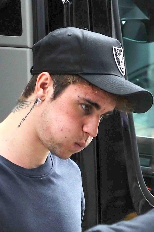 Vì sao Justin Bieber ngày càng tiều tụy, xuống dốc ngoại hình?-2