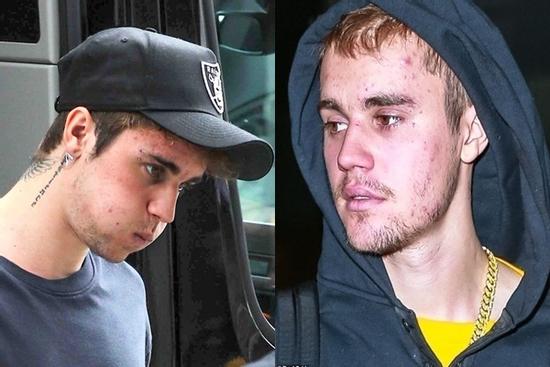 Vì sao Justin Bieber ngày càng tiều tụy, xuống dốc ngoại hình?