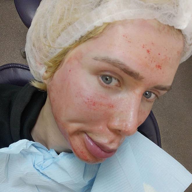 Sau nhiều lần dao kéo, chàng trai lại tiêm trắng để giống Jimin hơn-1