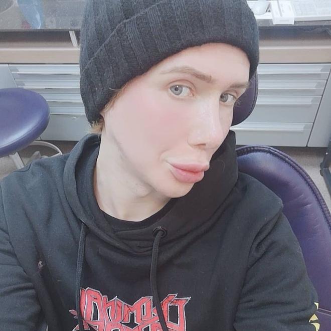 Sau nhiều lần dao kéo, chàng trai lại tiêm trắng để giống Jimin hơn-2