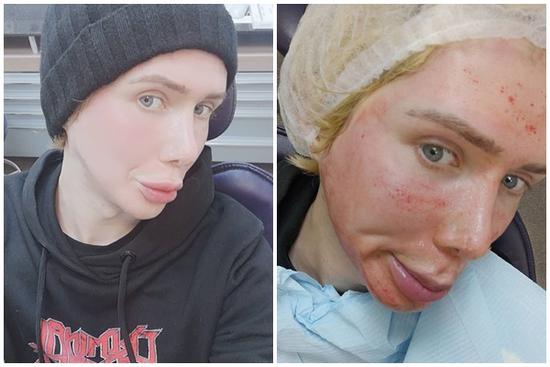 Sau nhiều lần dao kéo, chàng trai lại tiêm trắng để giống Jimin hơn