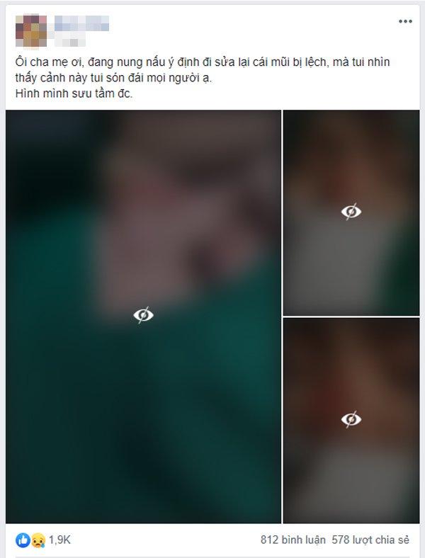 Cô gái bị bục da mũi, lộ hết sụn độn hậu nâng mũi: Đâu là bài học cho chị em?-1