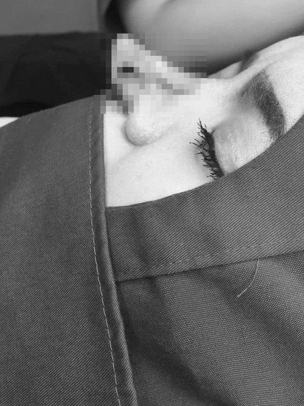 Cô gái bị bục da mũi, lộ hết sụn độn hậu nâng mũi: Đâu là bài học cho chị em?-2