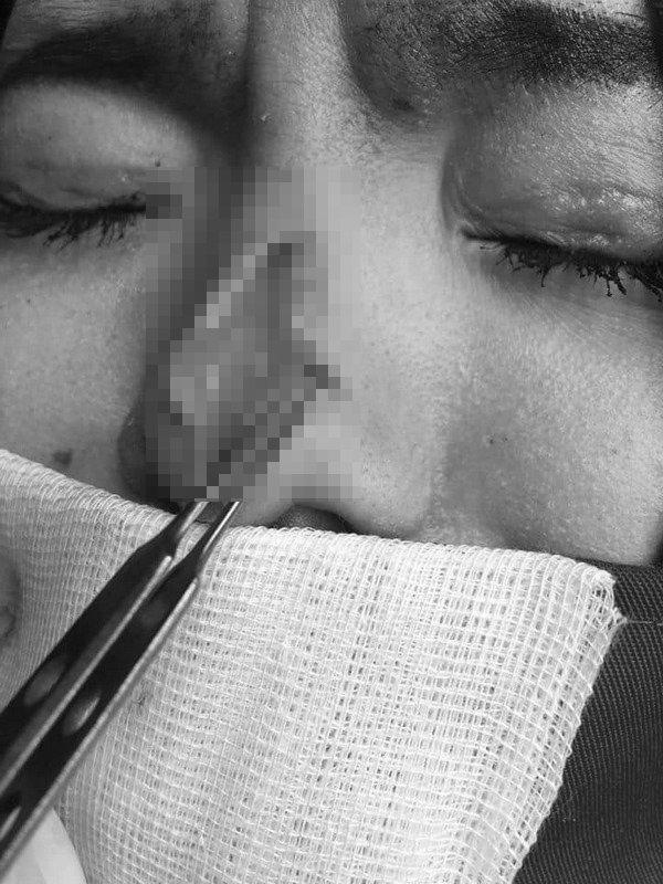 Cô gái bị bục da mũi, lộ hết sụn độn hậu nâng mũi: Đâu là bài học cho chị em?-4