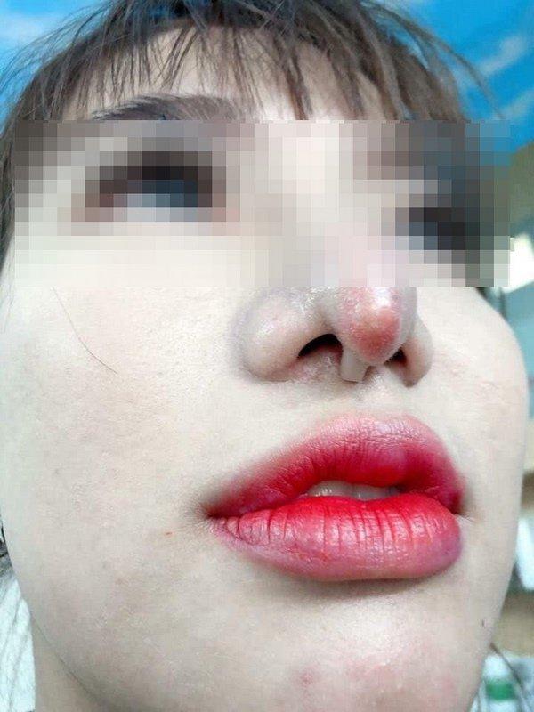 Cô gái bị bục da mũi, lộ hết sụn độn hậu nâng mũi: Đâu là bài học cho chị em?-7