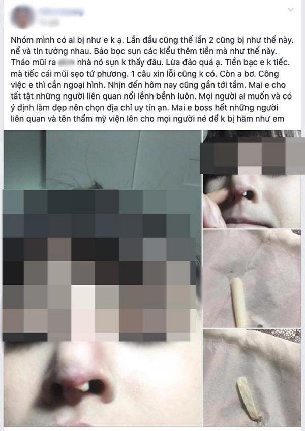 Cô gái bị bục da mũi, lộ hết sụn độn hậu nâng mũi: Đâu là bài học cho chị em?-10