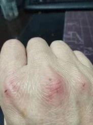 Bác sĩ ở Vũ Hán khám 300 bệnh nhân/ngày, tay trầy xước vì chất tẩy rửa-1