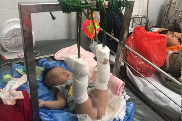 Thông tin mới nhất về sức khỏe của bé 4 tháng tuổi bị bố đánh gãy chân, xuất huyết não-1