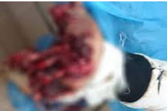 Thanh niên 19 tuổi phải cắt bỏ 3 ngón tay vì vừa sạc điện thoại vừa… chat