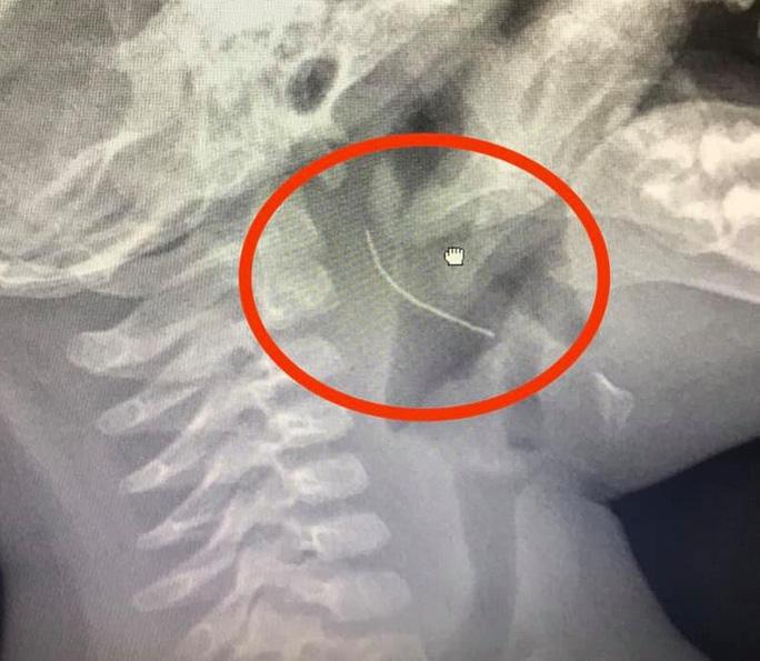 Mua cháo từ cửa hàng ăn, bé trai 13 tháng tuổi bị sợi thép đâm vào cổ họng-1