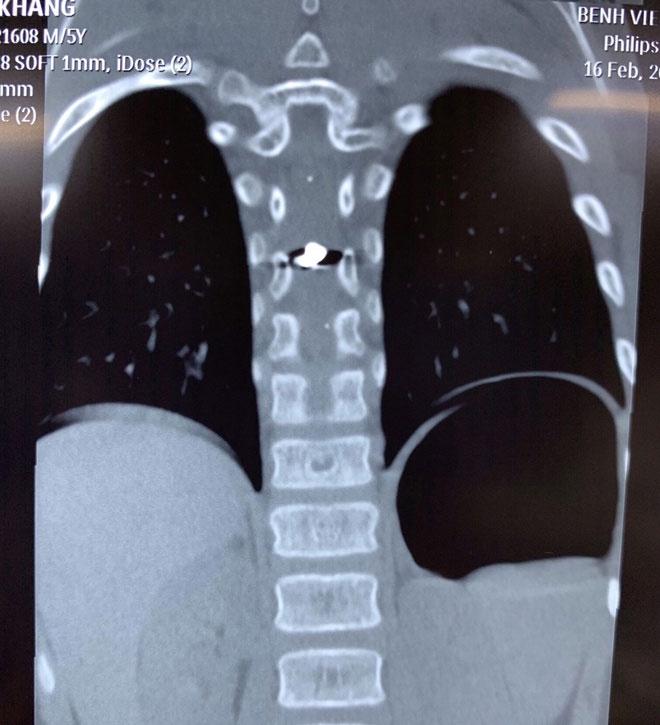 Bị anh bắn súng hơi vào lưng, bé 6 tuổi liệt nửa người-2