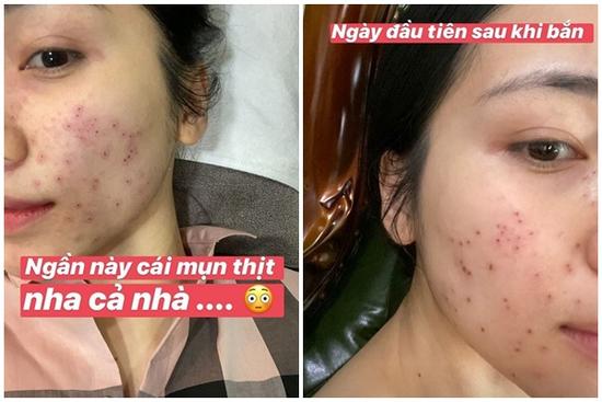 Hòa Minzy gây ám ảnh với gương mặt lỗ chỗ vì đốt laser mụn thịt