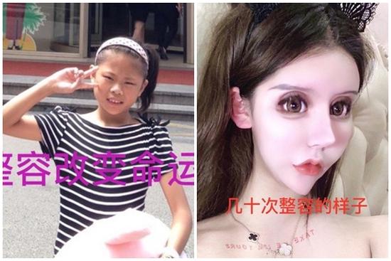 Gương mặt biến dạng của 10X phẫu thuật thẩm mỹ 60 lần từ năm 13 tuổi