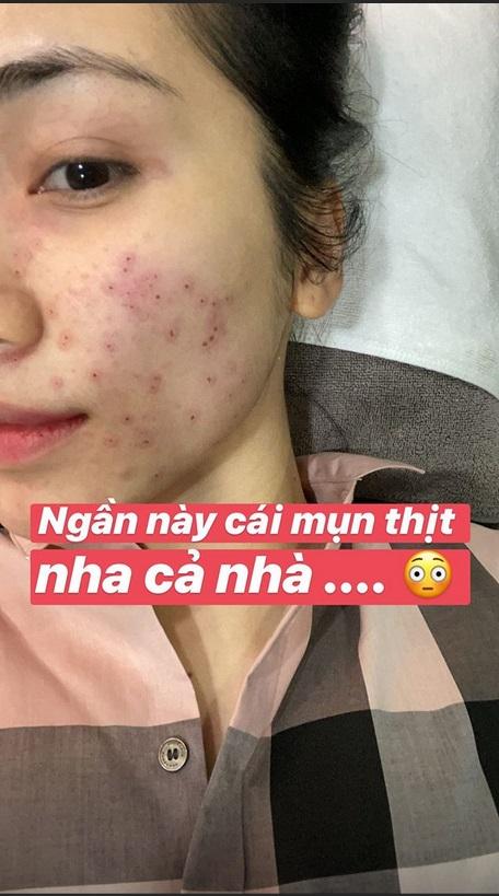 Không ngại xấu, Hòa Minzy công khai gương mặt sau 11 ngày bắn laser mụn thịt-1