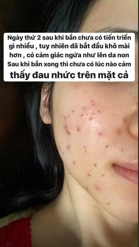 Không ngại xấu, Hòa Minzy công khai gương mặt sau 11 ngày bắn laser mụn thịt-4