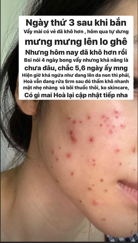 Không ngại xấu, Hòa Minzy công khai gương mặt sau 11 ngày bắn laser mụn thịt-5