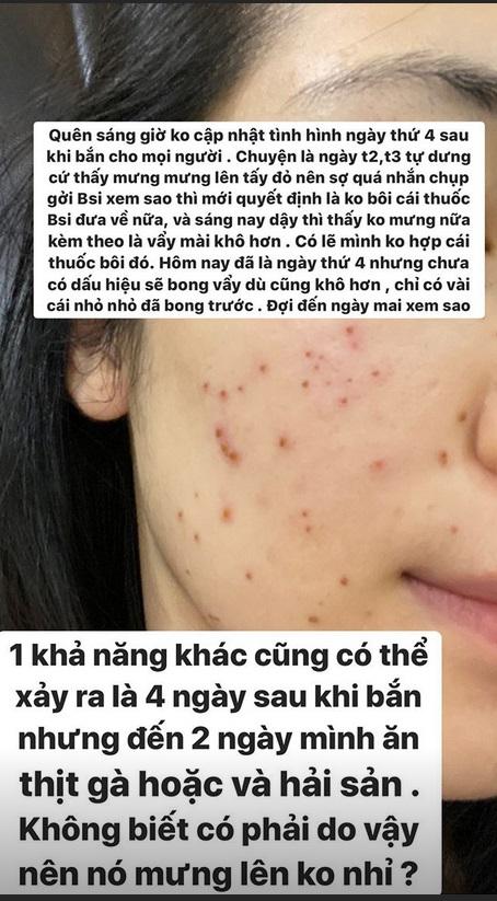 Không ngại xấu, Hòa Minzy công khai gương mặt sau 11 ngày bắn laser mụn thịt-6