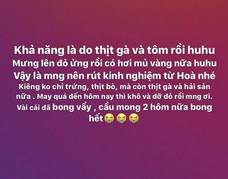Không ngại xấu, Hòa Minzy công khai gương mặt sau 11 ngày bắn laser mụn thịt-7