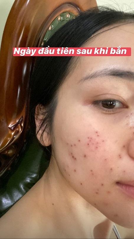 Không ngại xấu, Hòa Minzy công khai gương mặt sau 11 ngày bắn laser mụn thịt-3