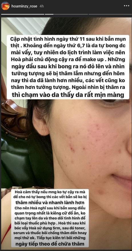 Không ngại xấu, Hòa Minzy công khai gương mặt sau 11 ngày bắn laser mụn thịt-9